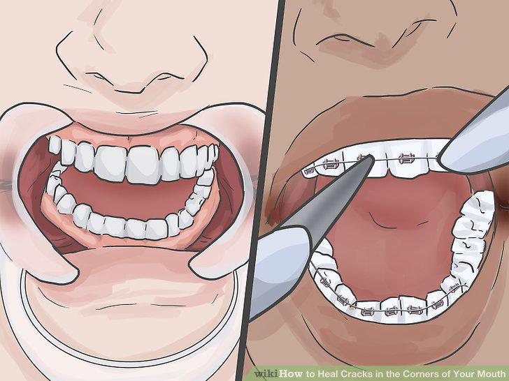 Step 12