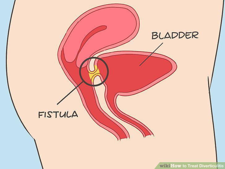 Step 11