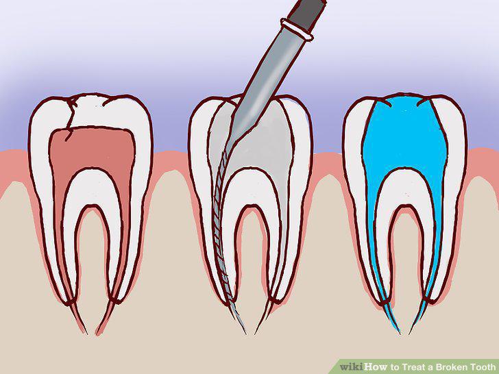 Step 14